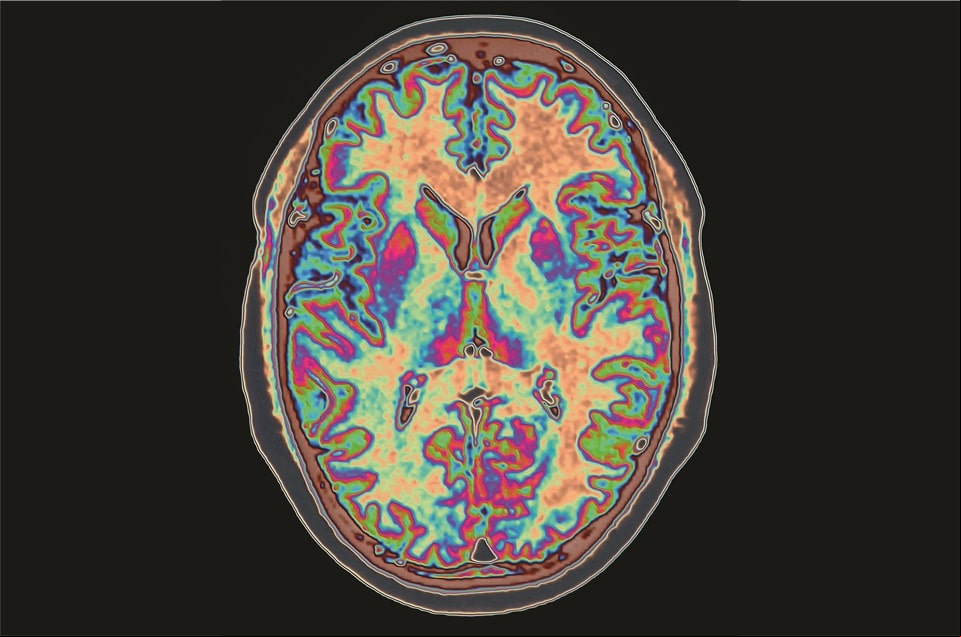 Droga que combate Alzheimer volta à cena como nova promessa