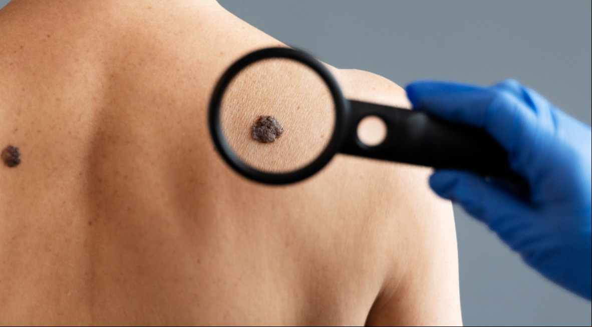 Homens e mulheres desenvolvem câncer de pele em regiões diferentes do corpo